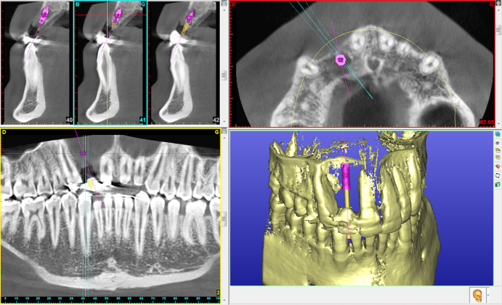 Autogreffe unitaire Maxillaire