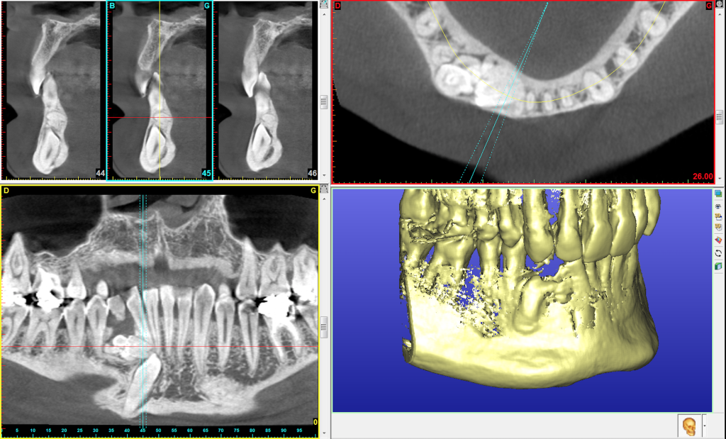 Canine incluse et odontoïdes multiples