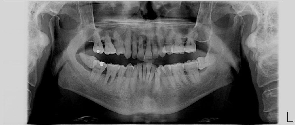 Dents de sagesse horizontales enkystees