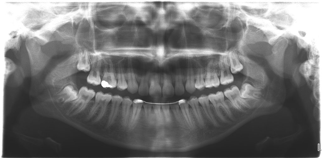 Dents de sagesse incluses