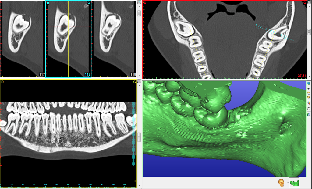 Dents de sagesse incluses