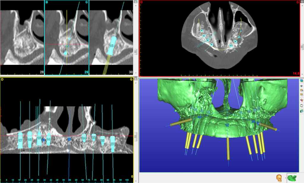 Double soulevement sinusal