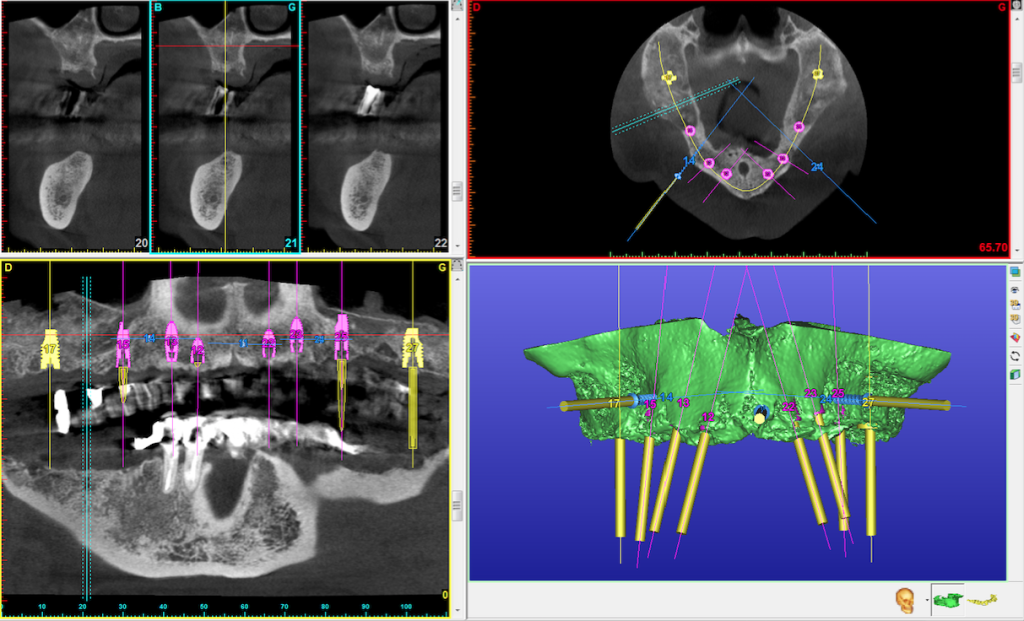 Double soulevement sinusal et greffes d