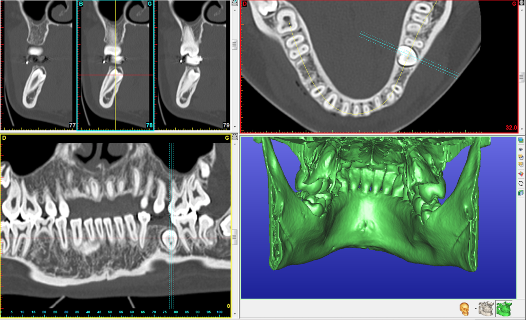Germectomies multiples