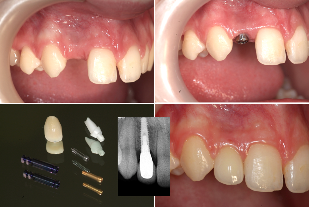 Implant secteur incisif