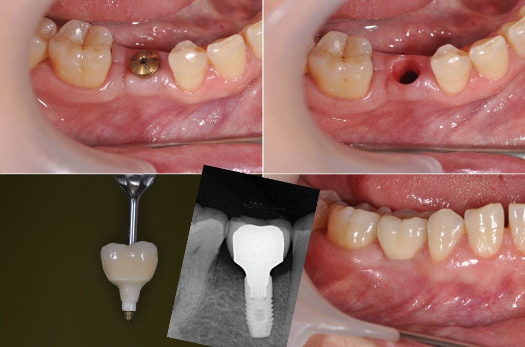 Implant secteur molaire