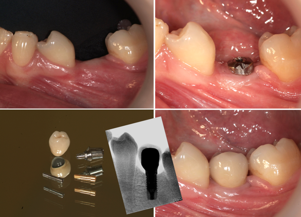Implant secteur prémolaire 
