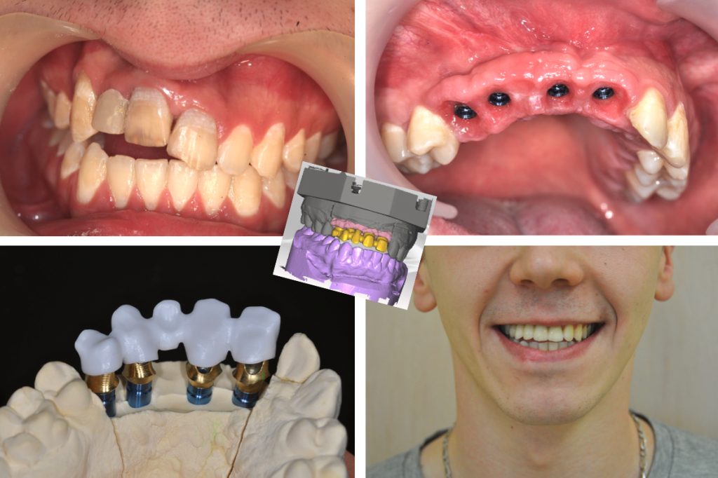 Implants - Après chirurgie pré-implanatire