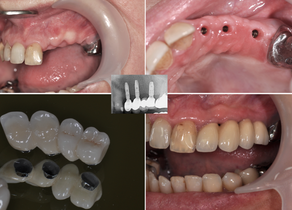 Implants - Bridge séquentiel