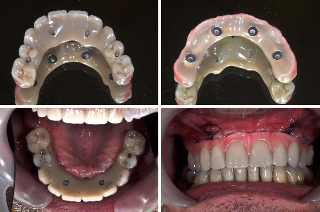 Implants - Prothèse complète  transvissée, un seul