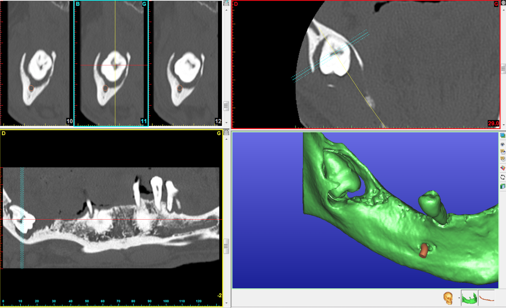 Kyste perforant de Dent de sagesse