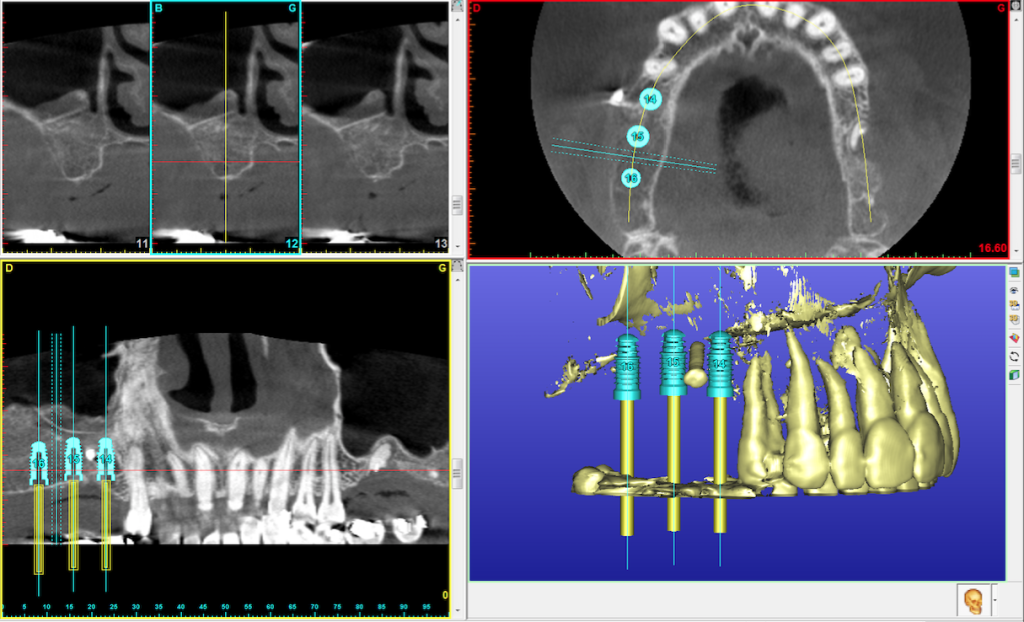Soulevement sinusal droit