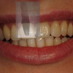 Traitement implantaire