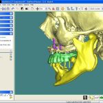 Traitement pré-implantaire
